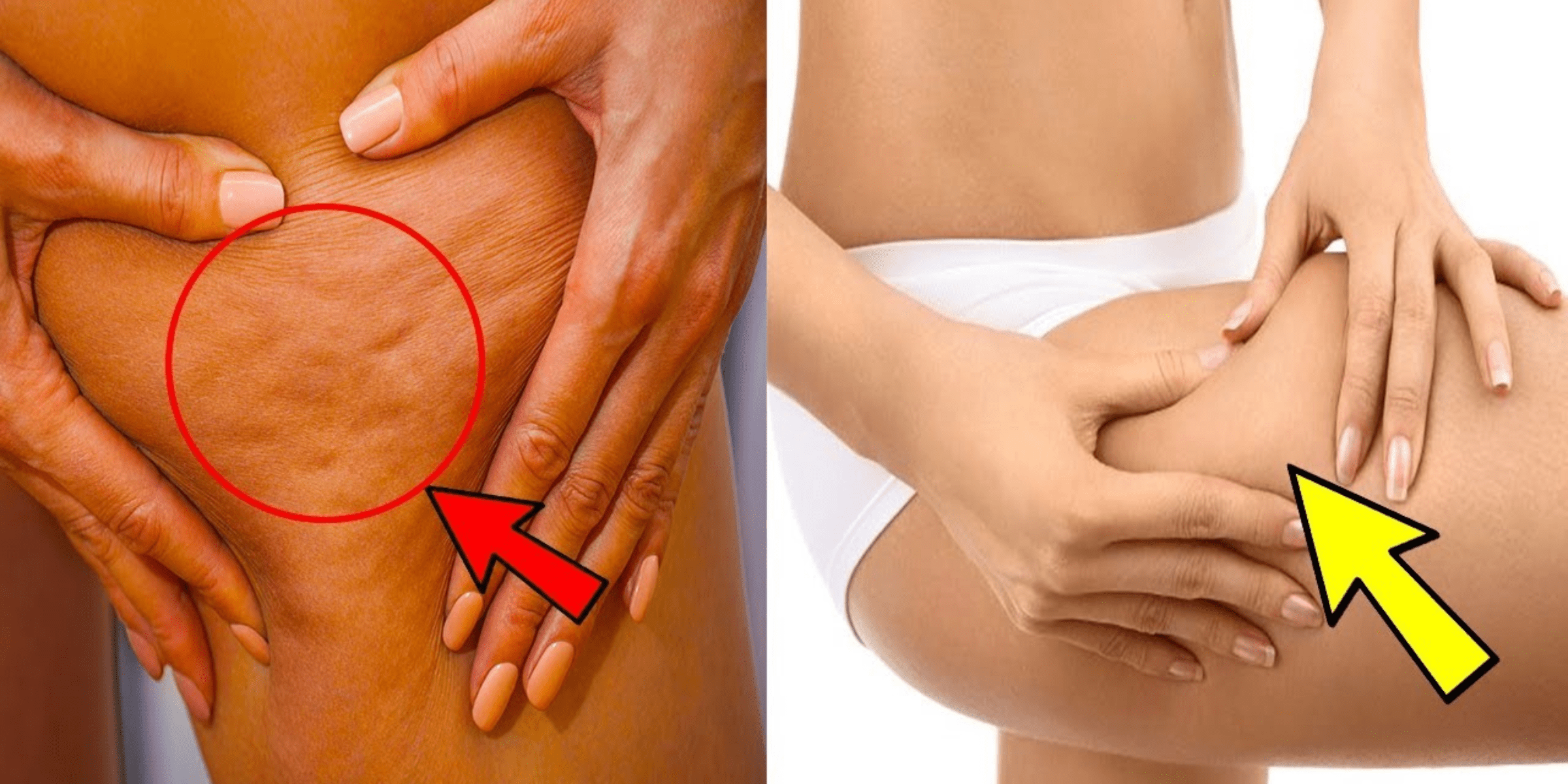 How can I get rid of cellulite fast naturally